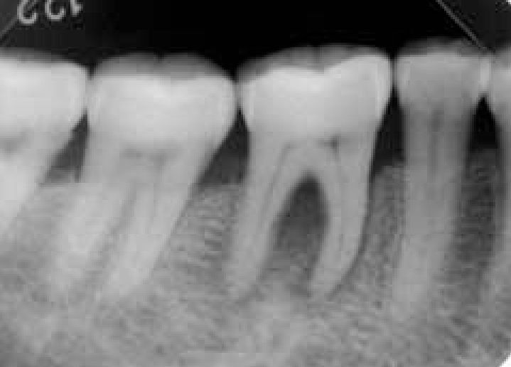 ray-photograph-of-tooth-46-at-first-visit-Bone-resorption-is-observed-at-the-furcation